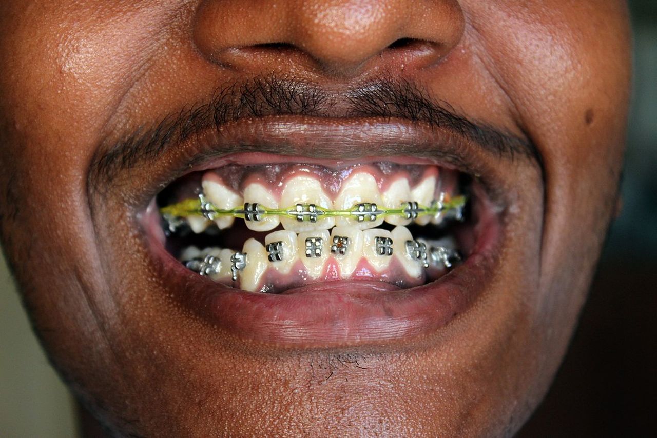 Braces Wallpapers